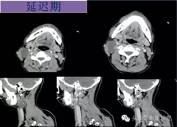 【病例】右颈部异位甲状腺1例CT影像表现