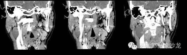 【病例】右颈部异位甲状腺1例CT影像表现