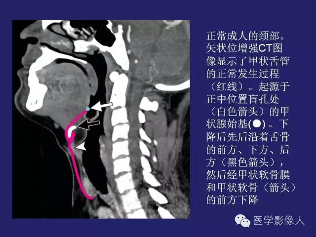 【PPT】异位甲状腺和甲状舌管囊肿影像学表现