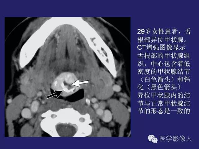 【PPT】异位甲状腺和甲状舌管囊肿影像学表现