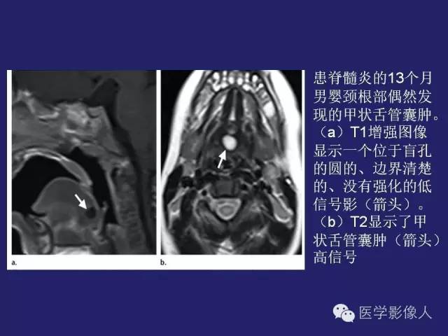【PPT】异位甲状腺和甲状舌管囊肿影像学表现
