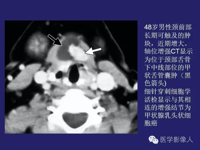 【PPT】异位甲状腺和甲状舌管囊肿影像学表现