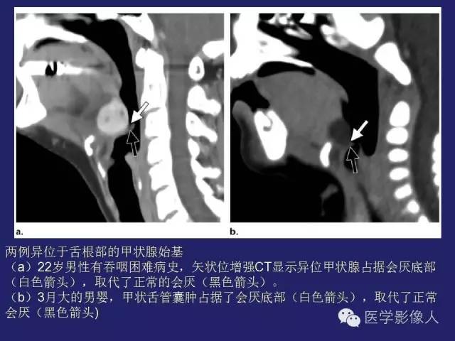 【PPT】异位甲状腺和甲状舌管囊肿影像学表现