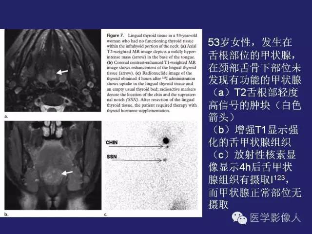 【PPT】异位甲状腺和甲状舌管囊肿影像学表现