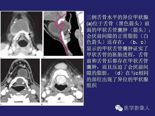 【PPT】异位甲状腺和甲状舌管囊肿影像学表现