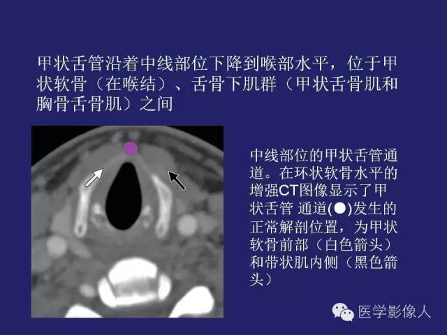 【PPT】异位甲状腺和甲状舌管囊肿影像学表现