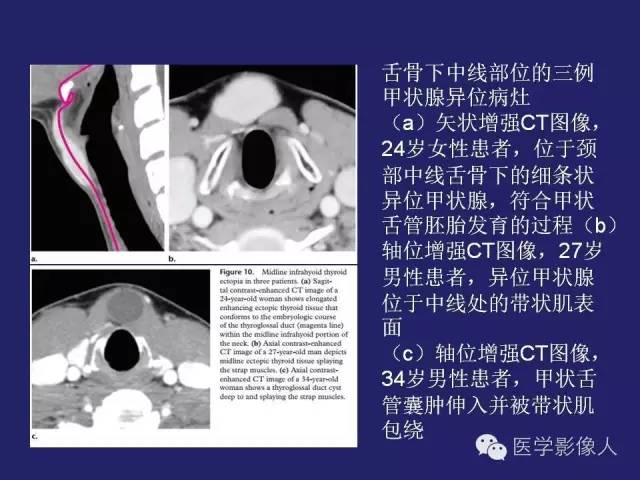 【PPT】异位甲状腺和甲状舌管囊肿影像学表现