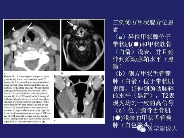 【PPT】异位甲状腺和甲状舌管囊肿影像学表现