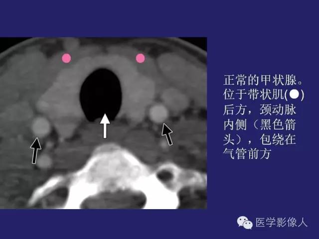 【PPT】异位甲状腺和甲状舌管囊肿影像学表现