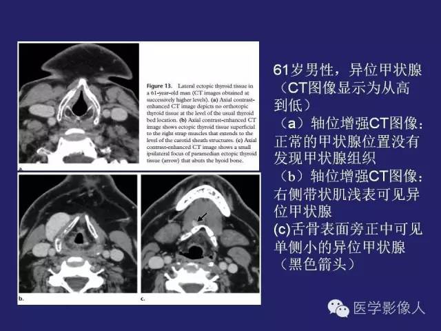 【PPT】异位甲状腺和甲状舌管囊肿影像学表现
