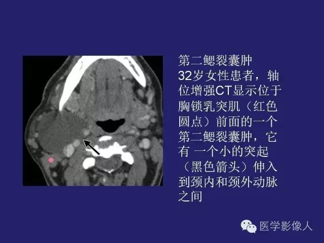 【PPT】异位甲状腺和甲状舌管囊肿影像学表现