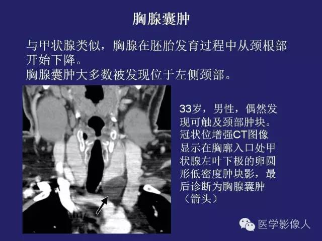 【PPT】异位甲状腺和甲状舌管囊肿影像学表现