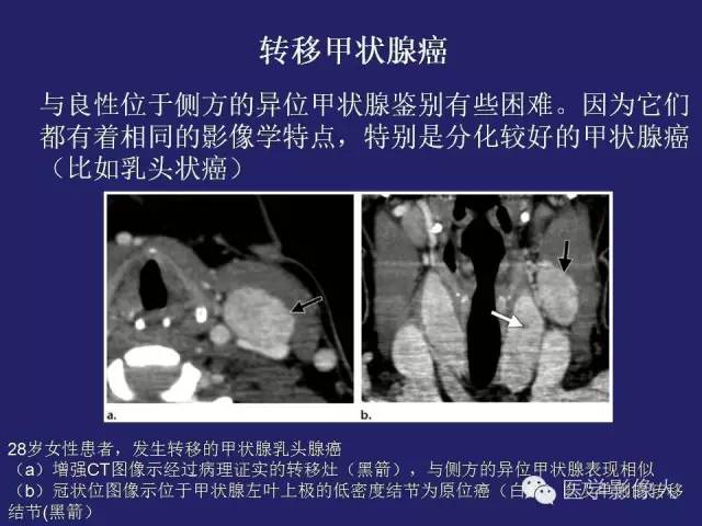 【PPT】异位甲状腺和甲状舌管囊肿影像学表现