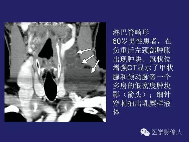 【PPT】异位甲状腺和甲状舌管囊肿影像学表现