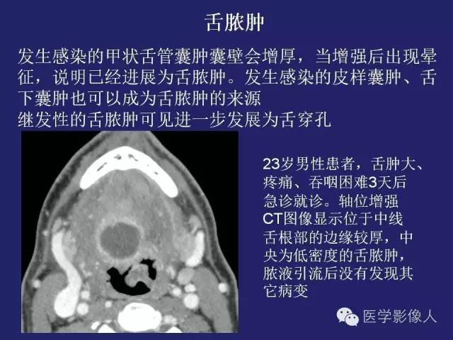 【PPT】异位甲状腺和甲状舌管囊肿影像学表现