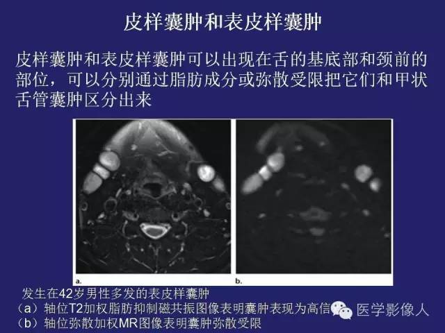 【PPT】异位甲状腺和甲状舌管囊肿影像学表现