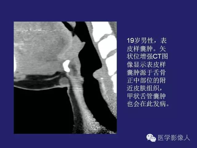 【PPT】异位甲状腺和甲状舌管囊肿影像学表现