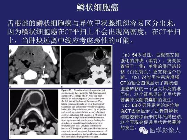 【PPT】异位甲状腺和甲状舌管囊肿影像学表现