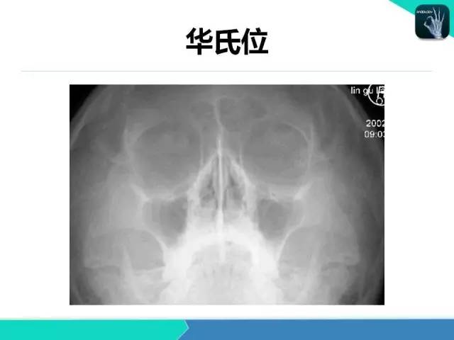 【PPT】鼻和鼻窦疾病影像学诊断