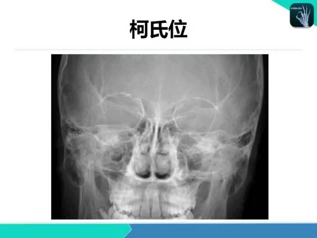 【PPT】鼻和鼻窦疾病影像学诊断