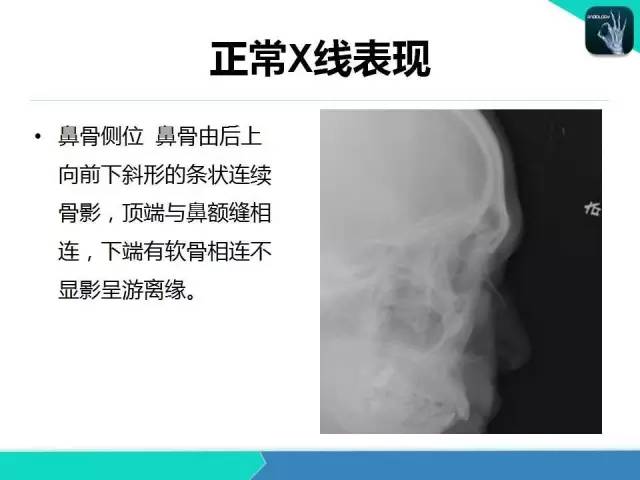 【PPT】鼻和鼻窦疾病影像学诊断