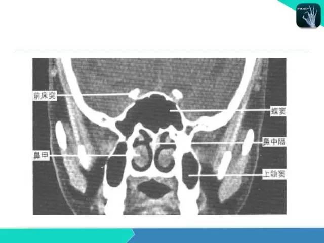 【PPT】鼻和鼻窦疾病影像学诊断
