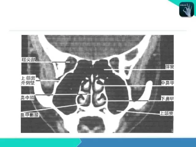 【PPT】鼻和鼻窦疾病影像学诊断