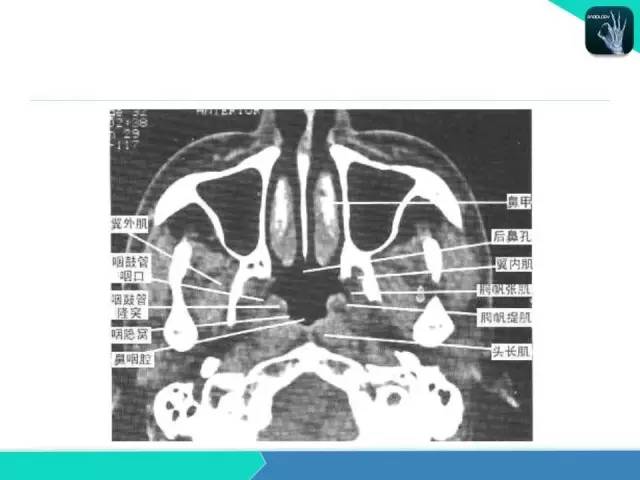 【PPT】鼻和鼻窦疾病影像学诊断