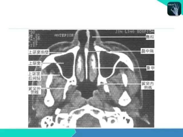 【PPT】鼻和鼻窦疾病影像学诊断