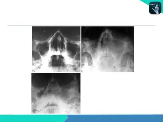 【PPT】鼻和鼻窦疾病影像学诊断