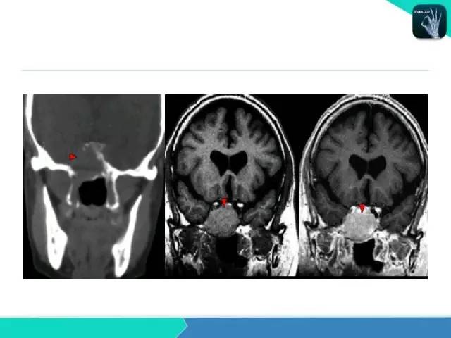 【PPT】鼻和鼻窦疾病影像学诊断