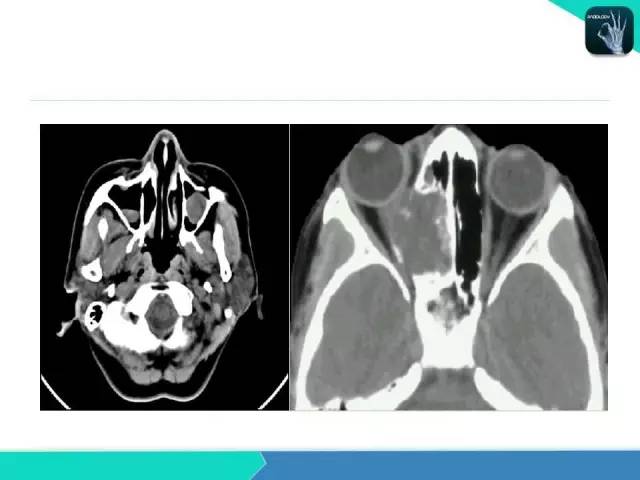 【PPT】鼻和鼻窦疾病影像学诊断