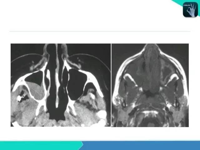 【PPT】鼻和鼻窦疾病影像学诊断
