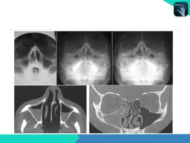 【PPT】鼻和鼻窦疾病影像学诊断