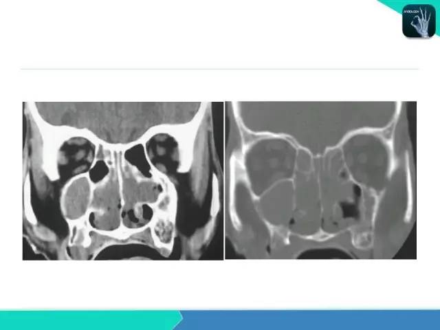 【PPT】鼻和鼻窦疾病影像学诊断
