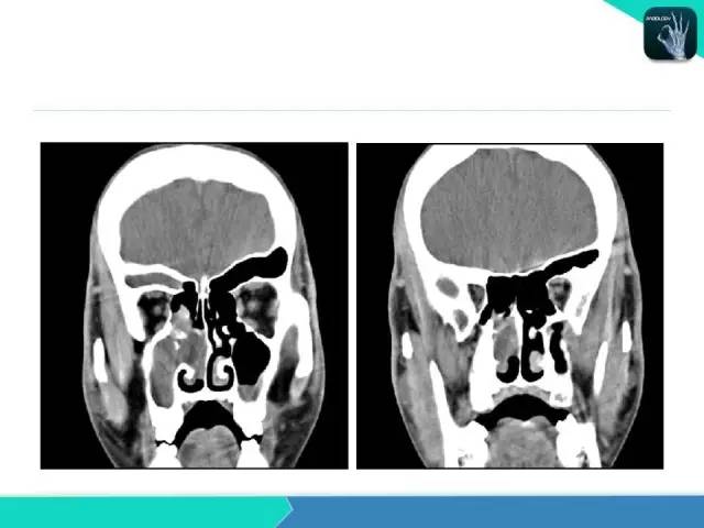 【PPT】鼻和鼻窦疾病影像学诊断