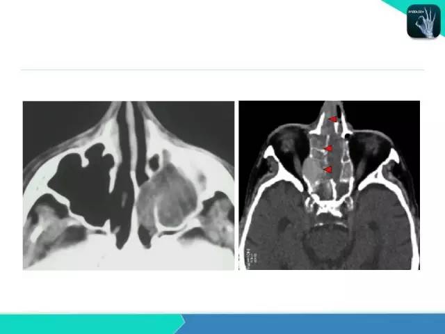 【PPT】鼻和鼻窦疾病影像学诊断