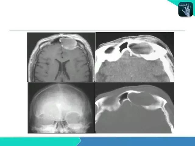 【PPT】鼻和鼻窦疾病影像学诊断
