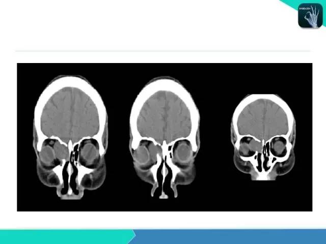 【PPT】鼻和鼻窦疾病影像学诊断