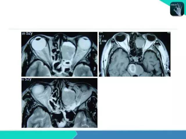 【PPT】鼻和鼻窦疾病影像学诊断