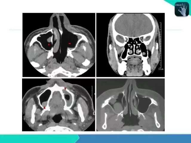 【PPT】鼻和鼻窦疾病影像学诊断