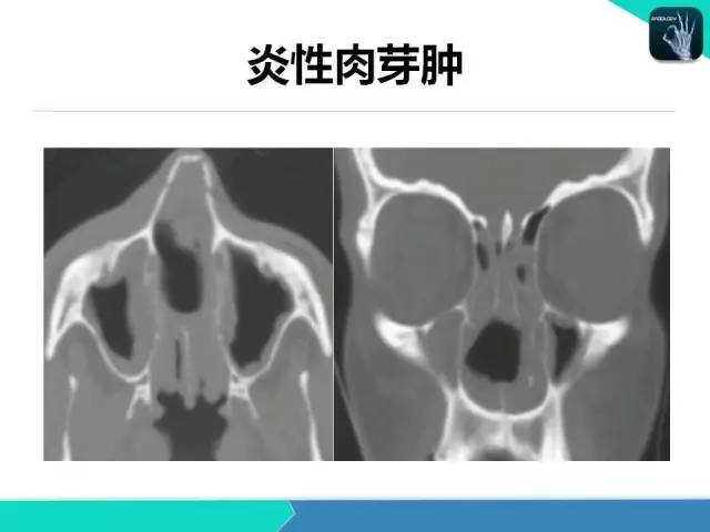 【PPT】鼻和鼻窦疾病影像学诊断