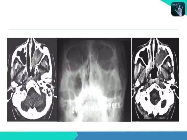 【PPT】鼻和鼻窦疾病影像学诊断