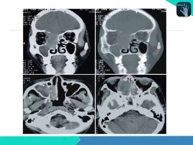 【PPT】鼻和鼻窦疾病影像学诊断