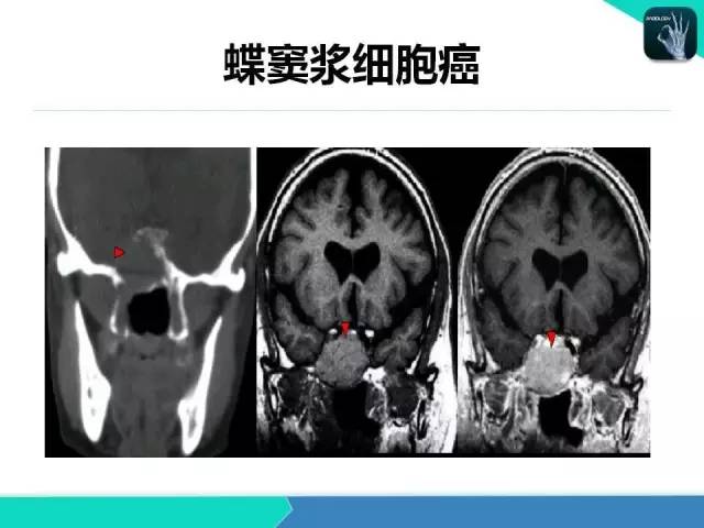 【PPT】鼻和鼻窦疾病影像学诊断