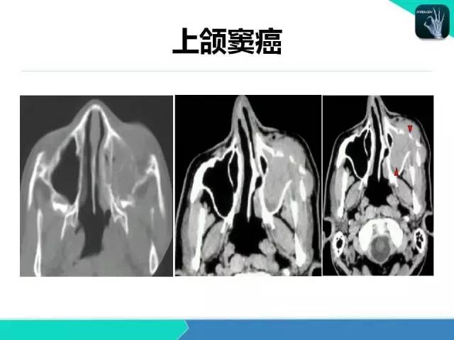 【PPT】鼻和鼻窦疾病影像学诊断
