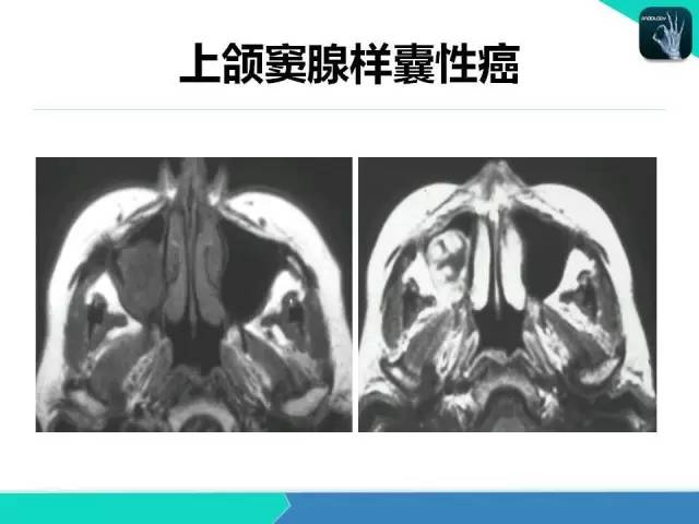 【PPT】鼻和鼻窦疾病影像学诊断