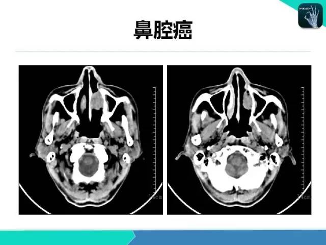 【PPT】鼻和鼻窦疾病影像学诊断