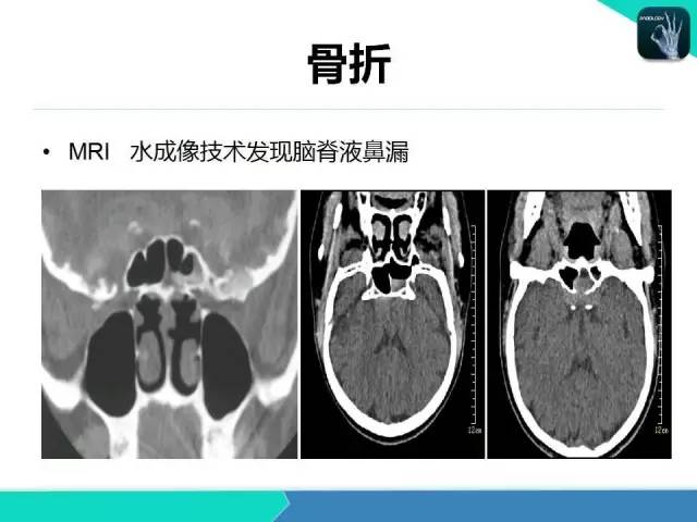 【PPT】鼻和鼻窦疾病影像学诊断
