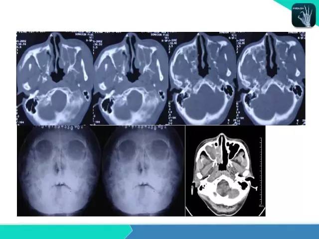 【PPT】鼻和鼻窦疾病影像学诊断